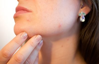 Causes and Treatments for Blackheads