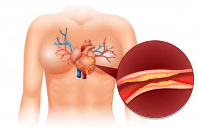 9 Causes of High Cholesterol in 2020