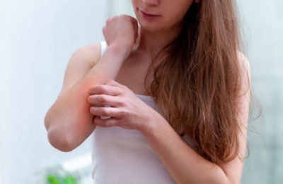 Ways to manage Psoriasis